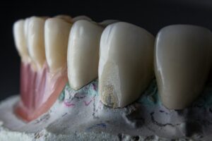 Remplacer une dent manquante