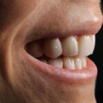Remplacer une dent manquante