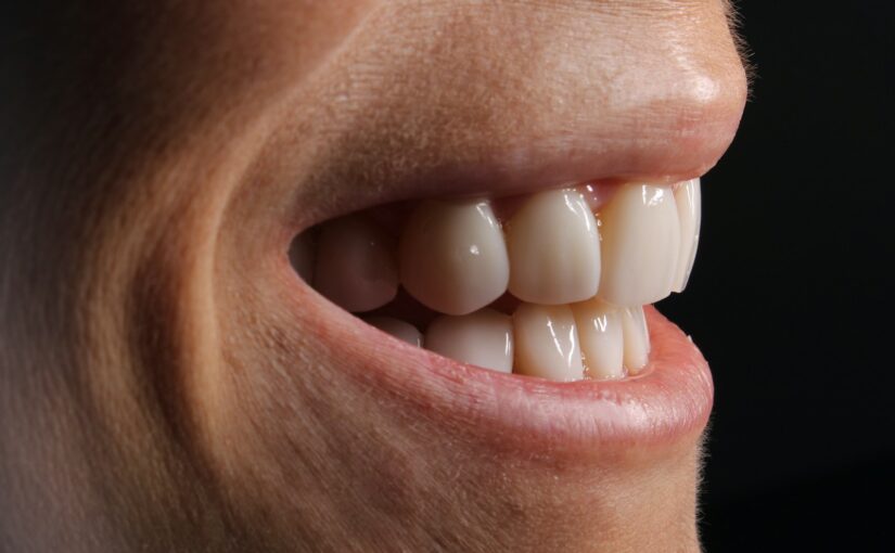 Remplacer une dent manquante